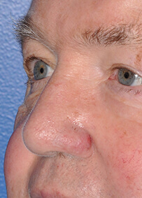 Nose Reconstruction