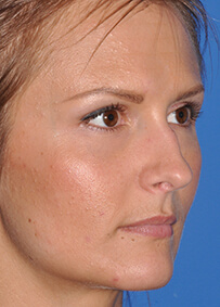 Rhinoplasty