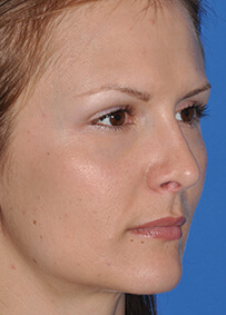 Rhinoplasty