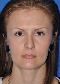 Rhinoplasty