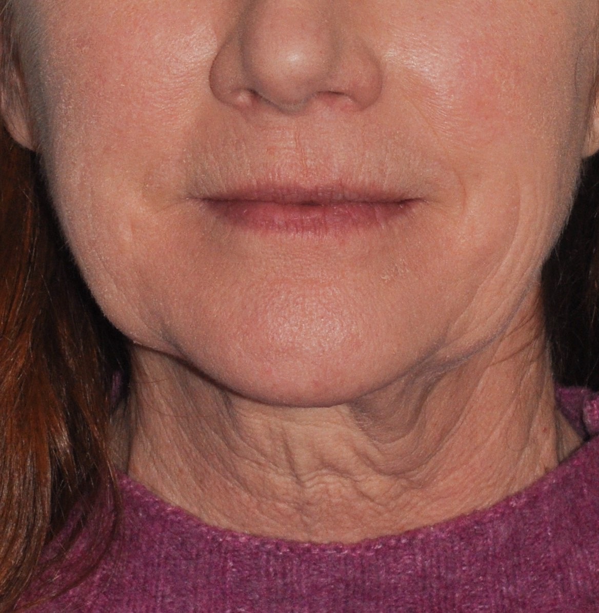 Face & Neck Lift