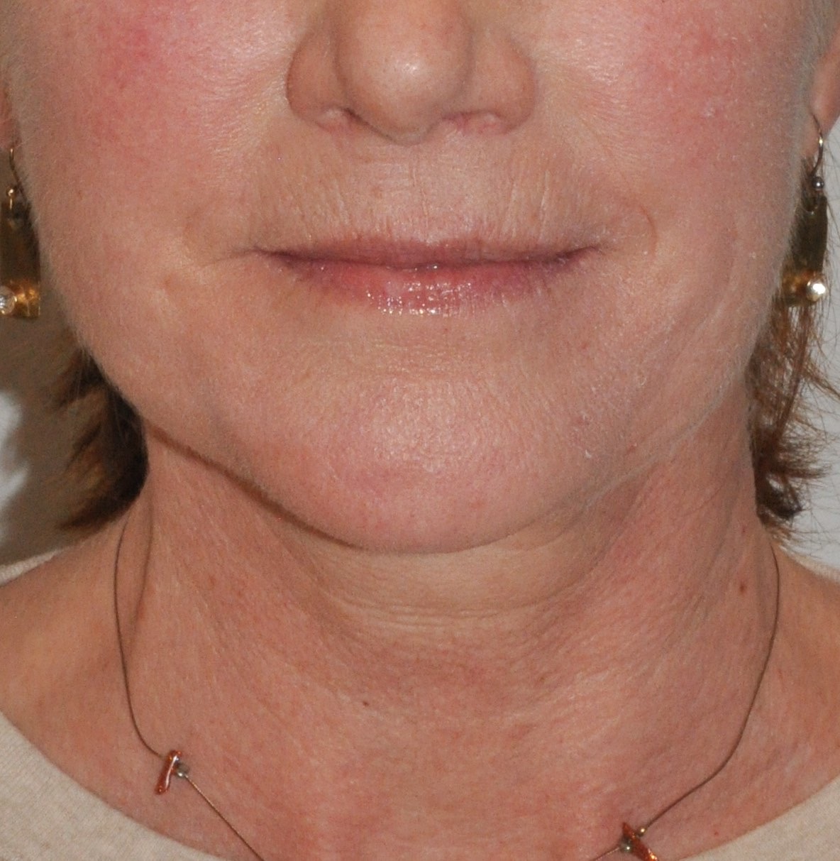 Face & Neck Lift