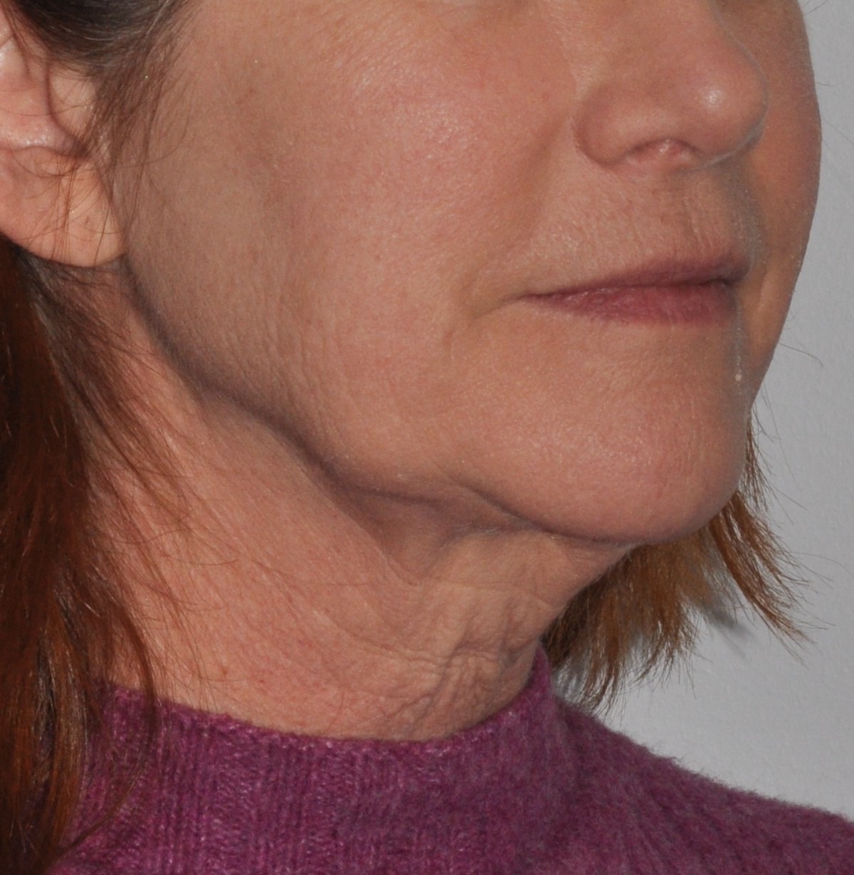 Face & Neck Lift