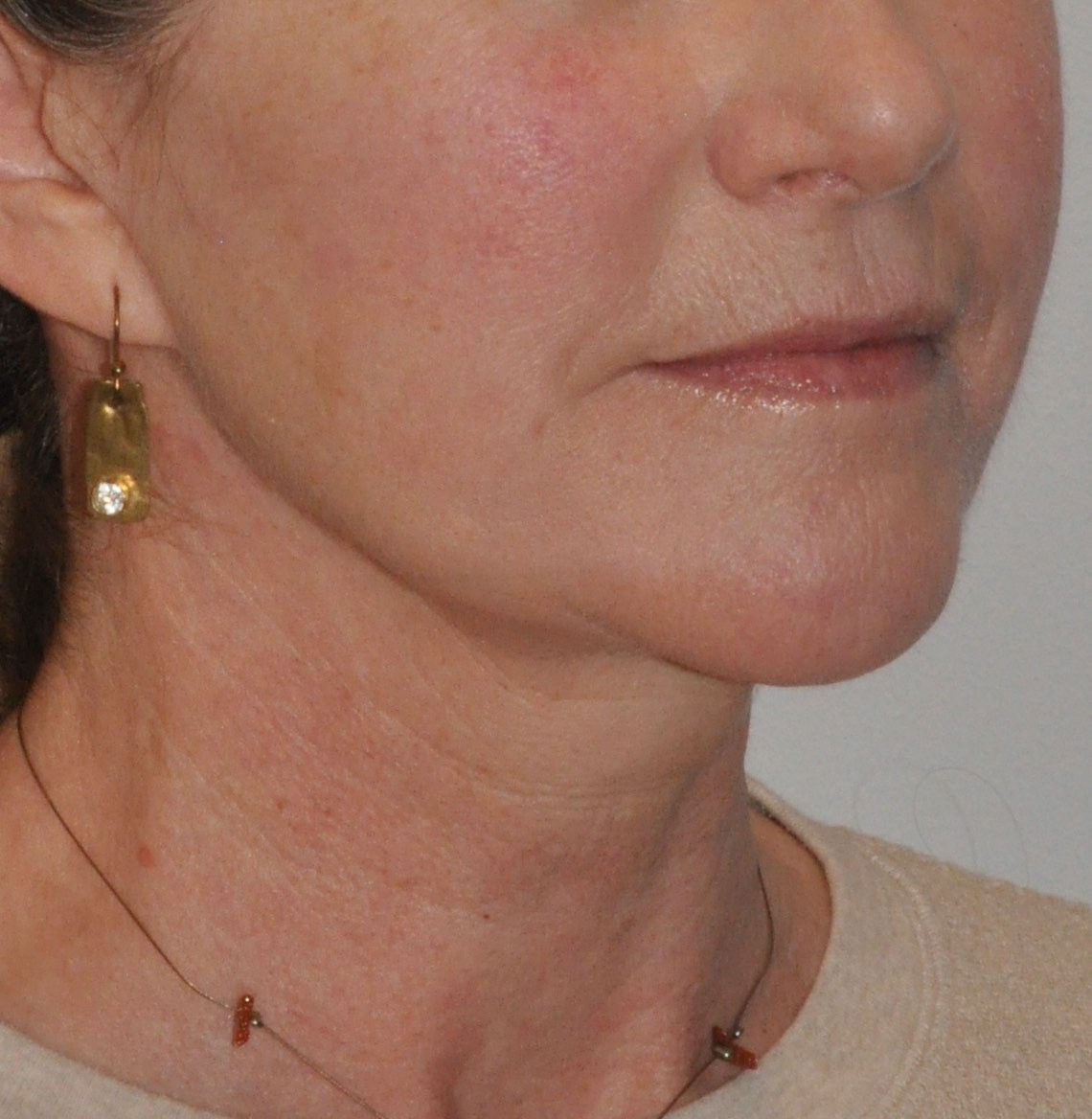 Face & Neck Lift