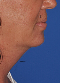 Kybella