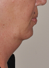 Kybella