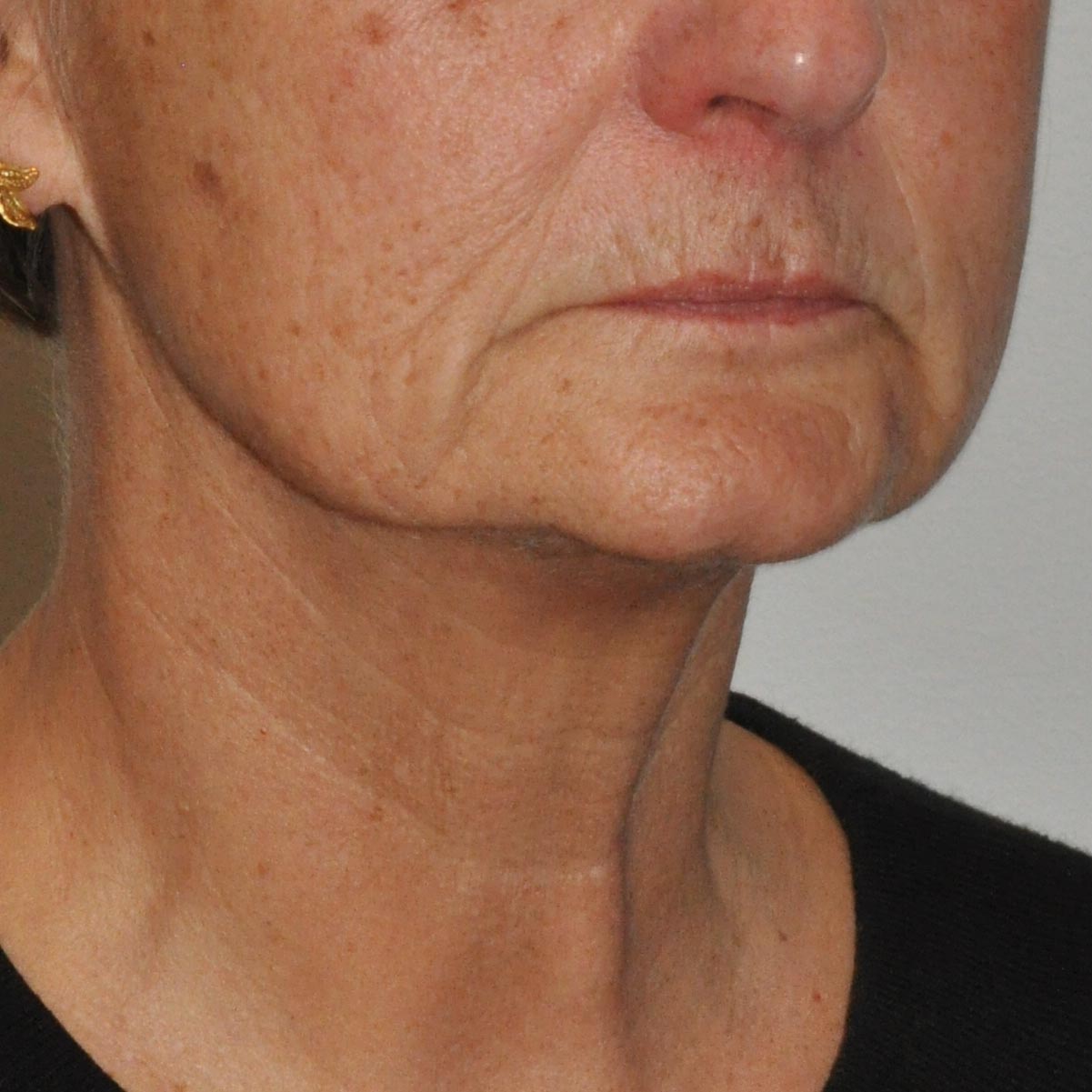 Face & Neck Lift