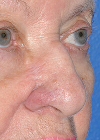 Nose Reconstruction