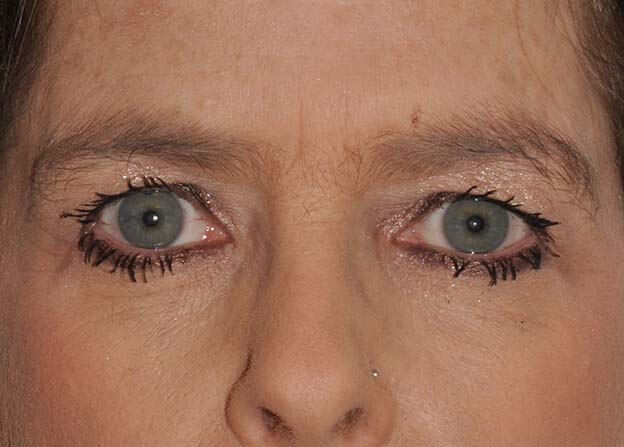 Blepharoplasty (Eyelid Lift)