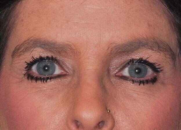 Blepharoplasty (Eyelid Lift)