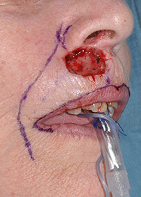 Lip Reconstruction