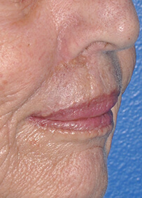 Lip Reconstruction