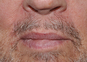 Lip Reconstruction