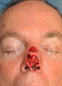 Nose Reconstruction