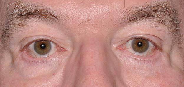 Blepharoplasty (Eyelid Lift)