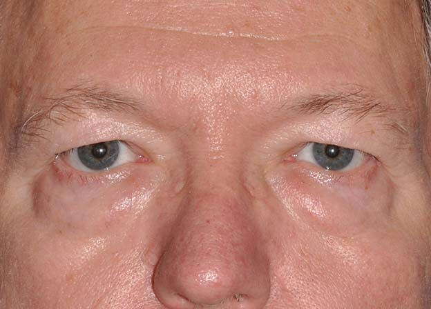 Blepharoplasty (Eyelid Lift)