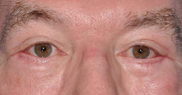 Blepharoplasty (Eyelid Lift)