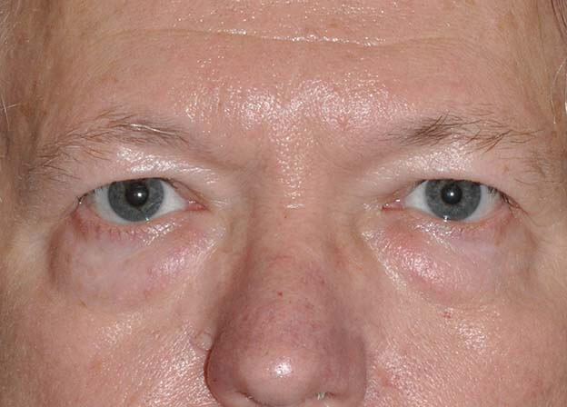 Blepharoplasty (Eyelid Lift)