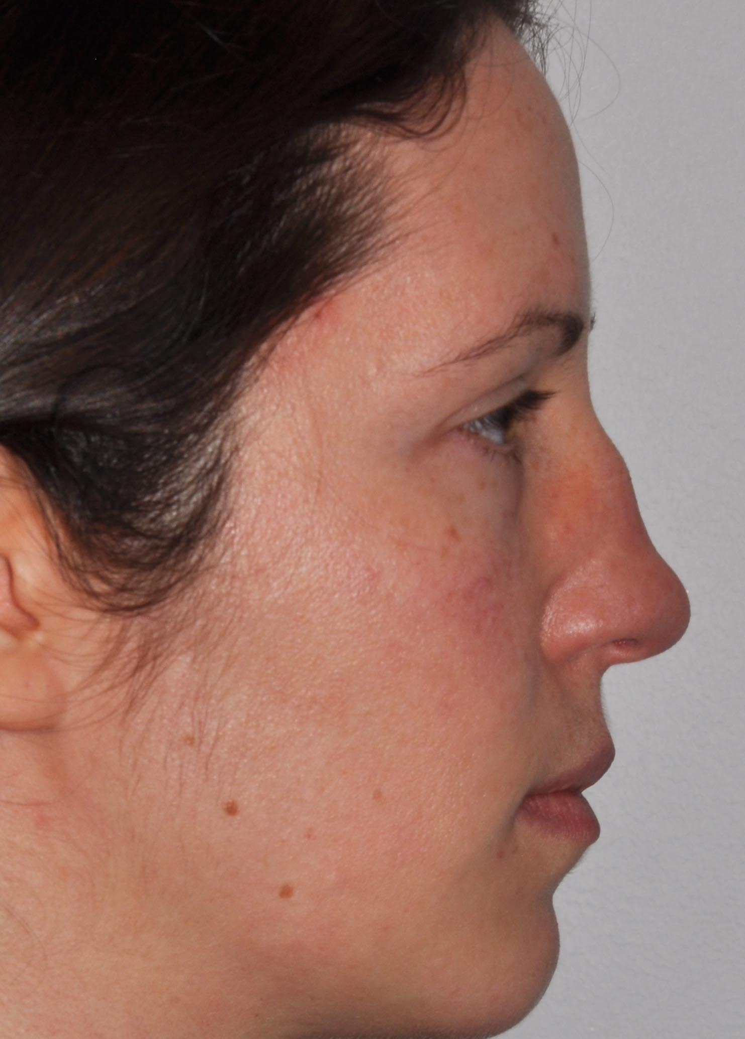 Revision Rhinoplasty