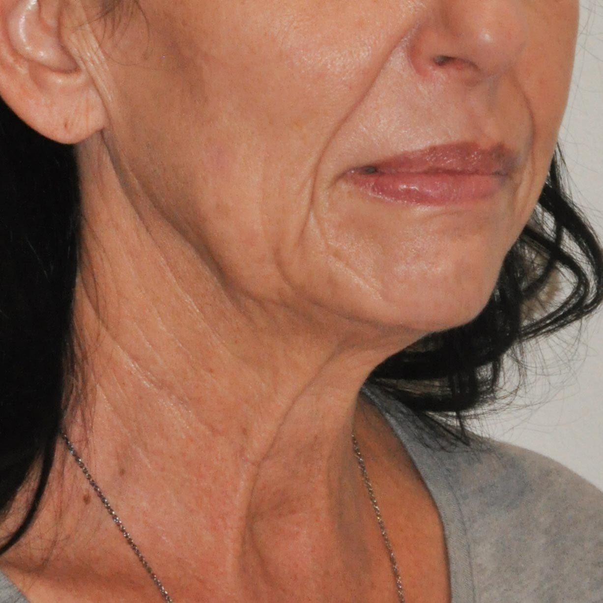 Face & Neck Lift