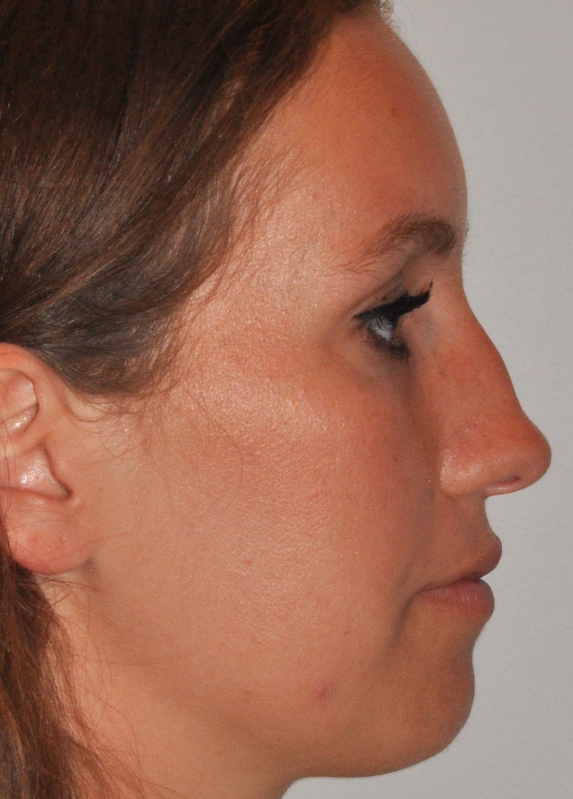 Rhinoplasty