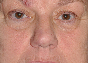 Nose Reconstruction