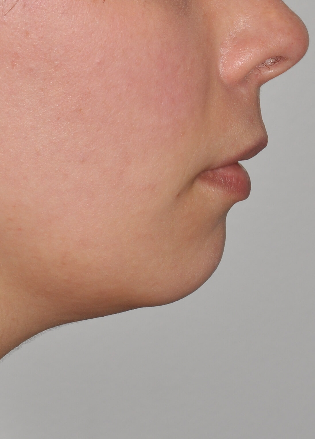 Chin Augmentation