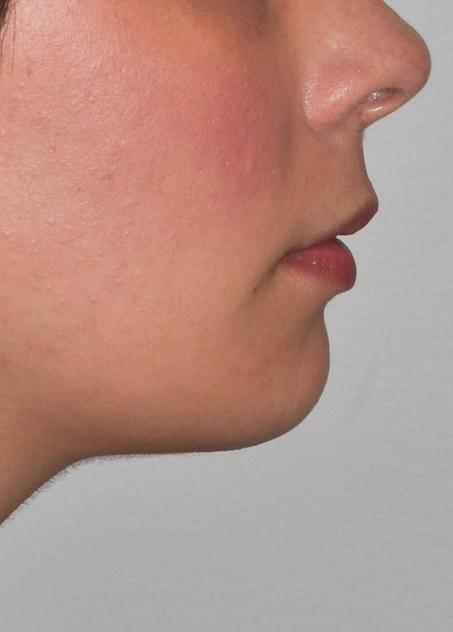 Chin Augmentation