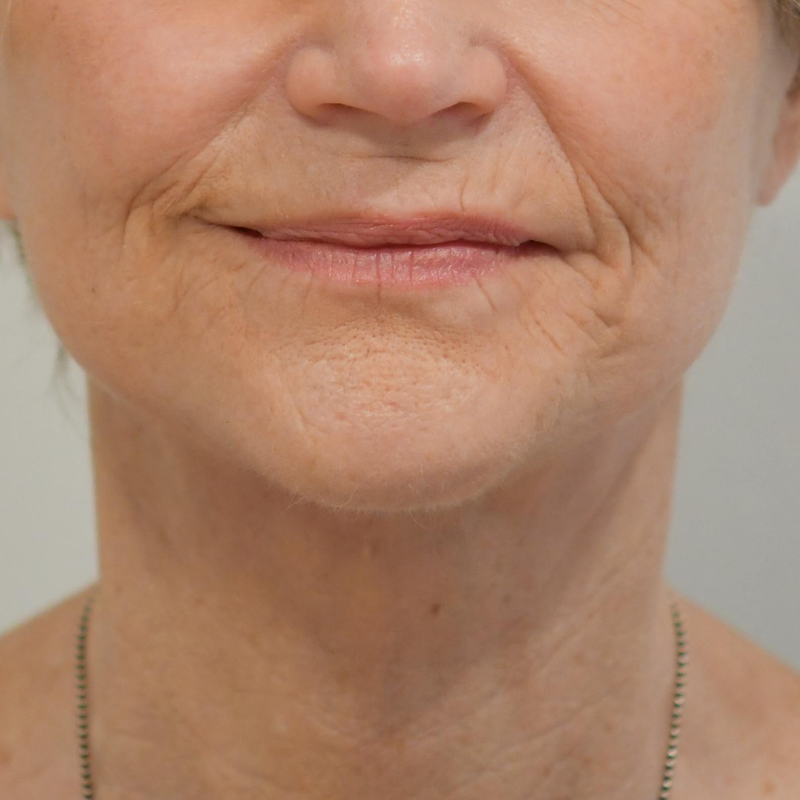 Face & Neck Lift