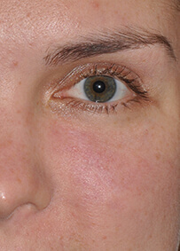 Eyelid & Cheek Reconstruction