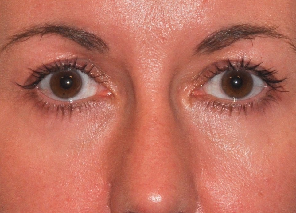 Blepharoplasty (Eyelid Lift)