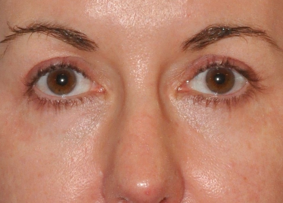 Blepharoplasty (Eyelid Lift)