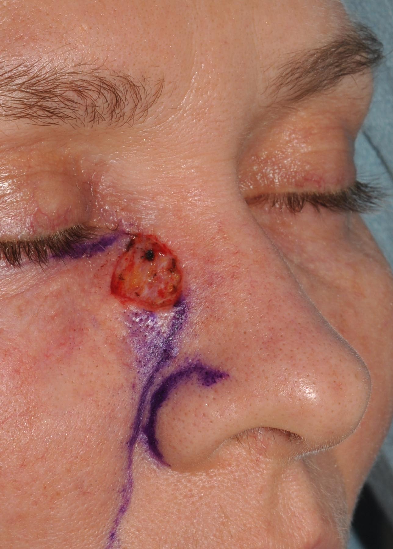 Eyelid & Cheek Reconstruction