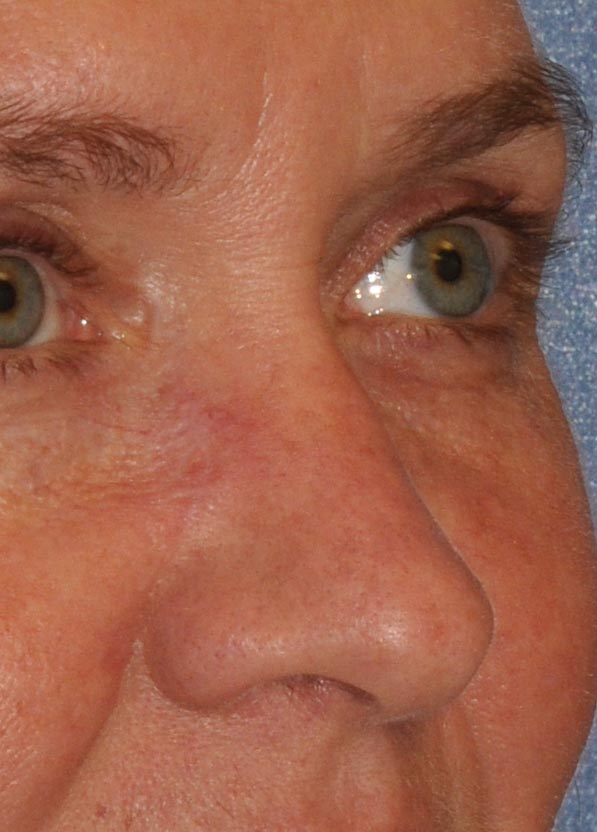 Eyelid & Cheek Reconstruction