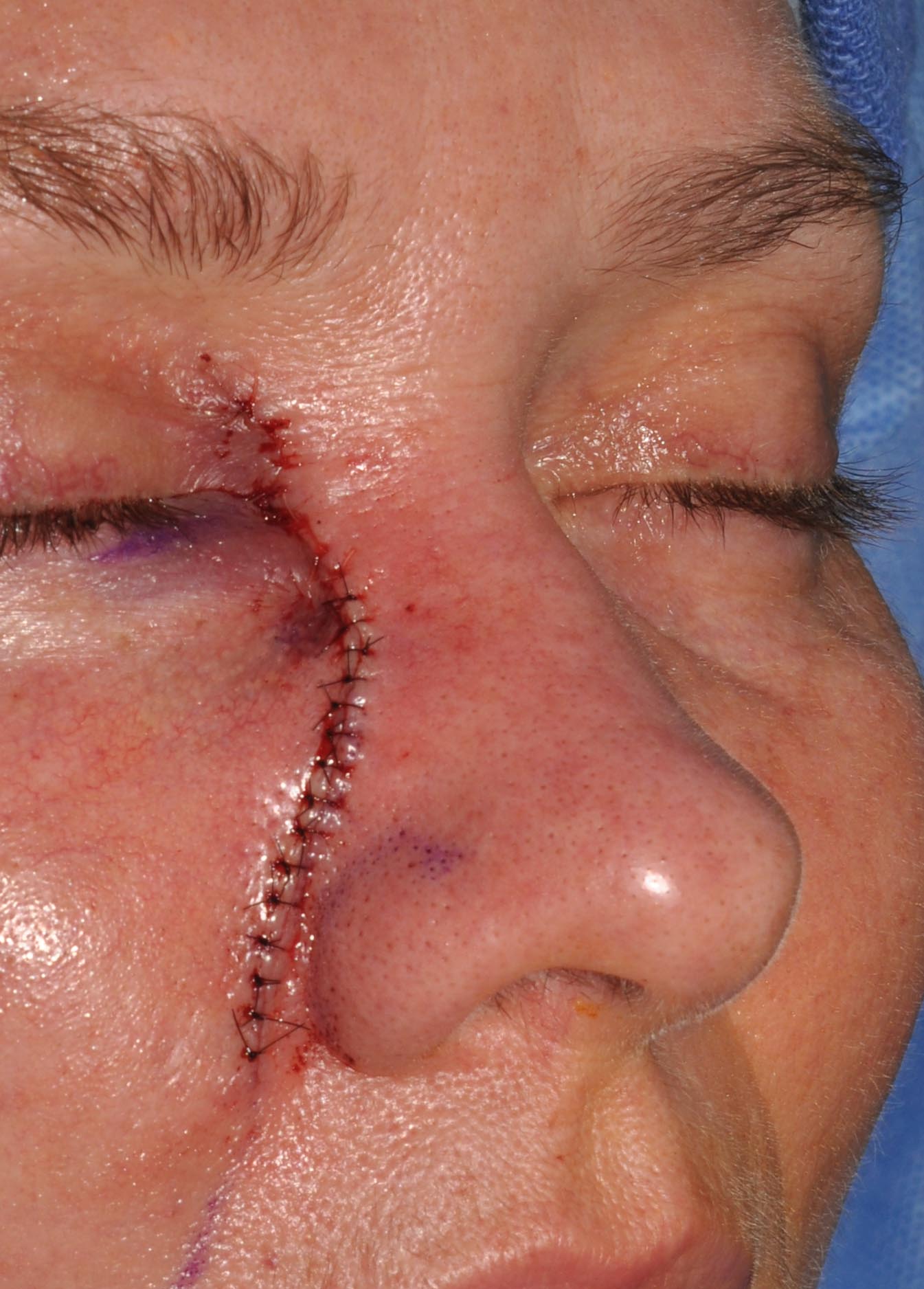 Eyelid & Cheek Reconstruction