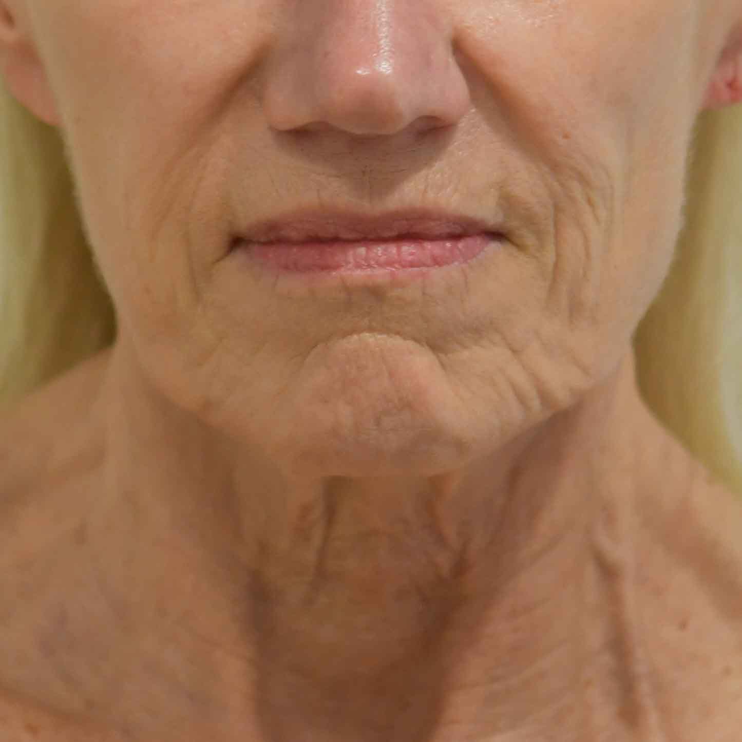 Facial Fat Grafting