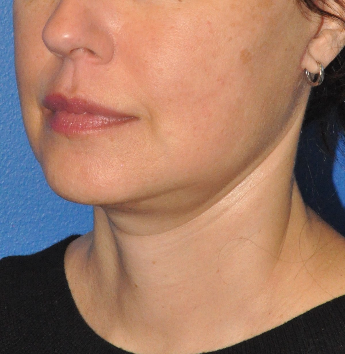 Face & Neck Lift