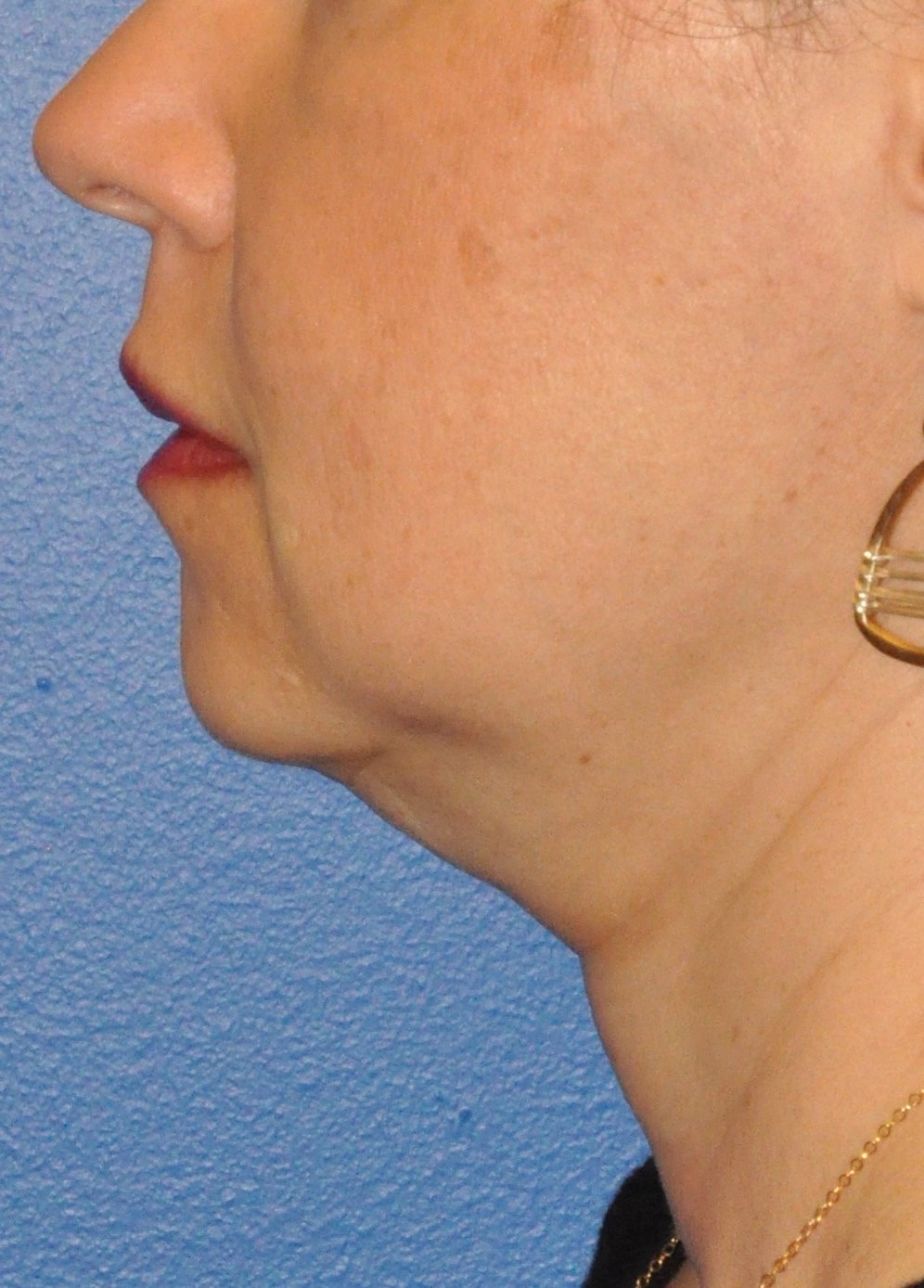 Face & Neck Lift