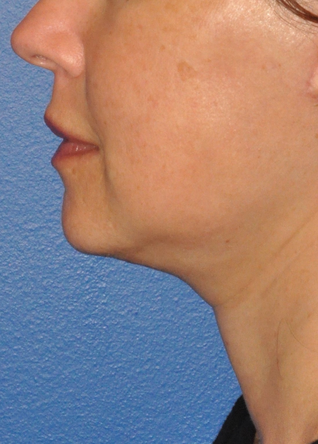 Face & Neck Lift