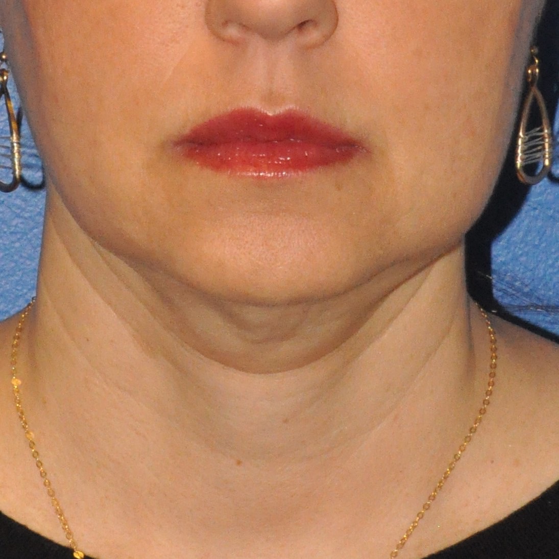 Face & Neck Lift