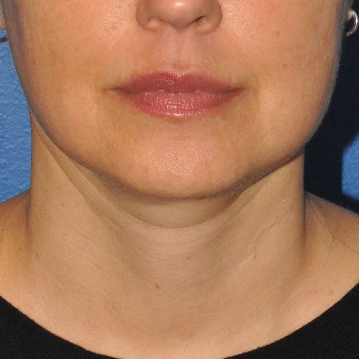 Face & Neck Lift