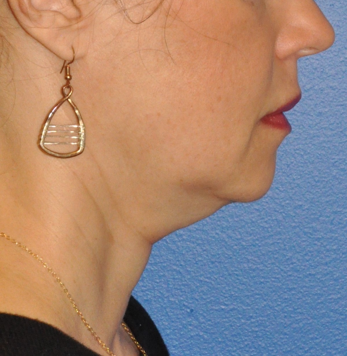 Face & Neck Lift