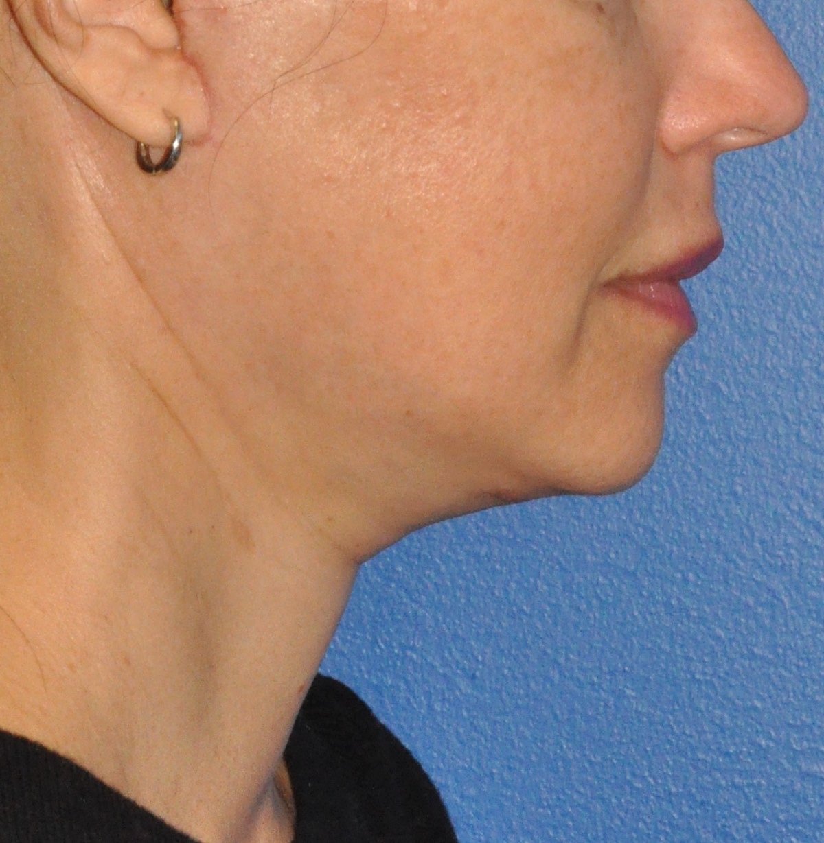 Face & Neck Lift