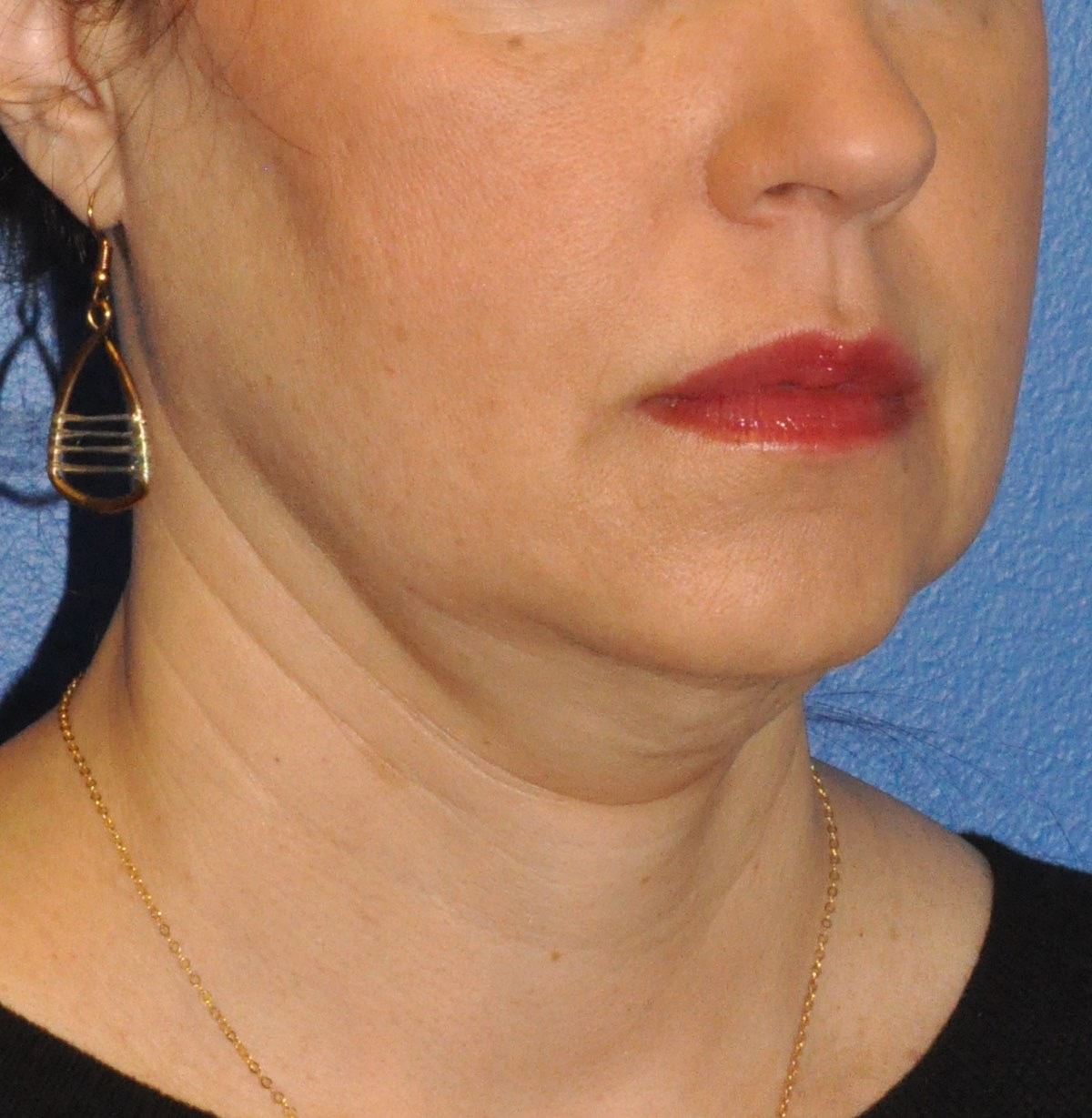 Face & Neck Lift