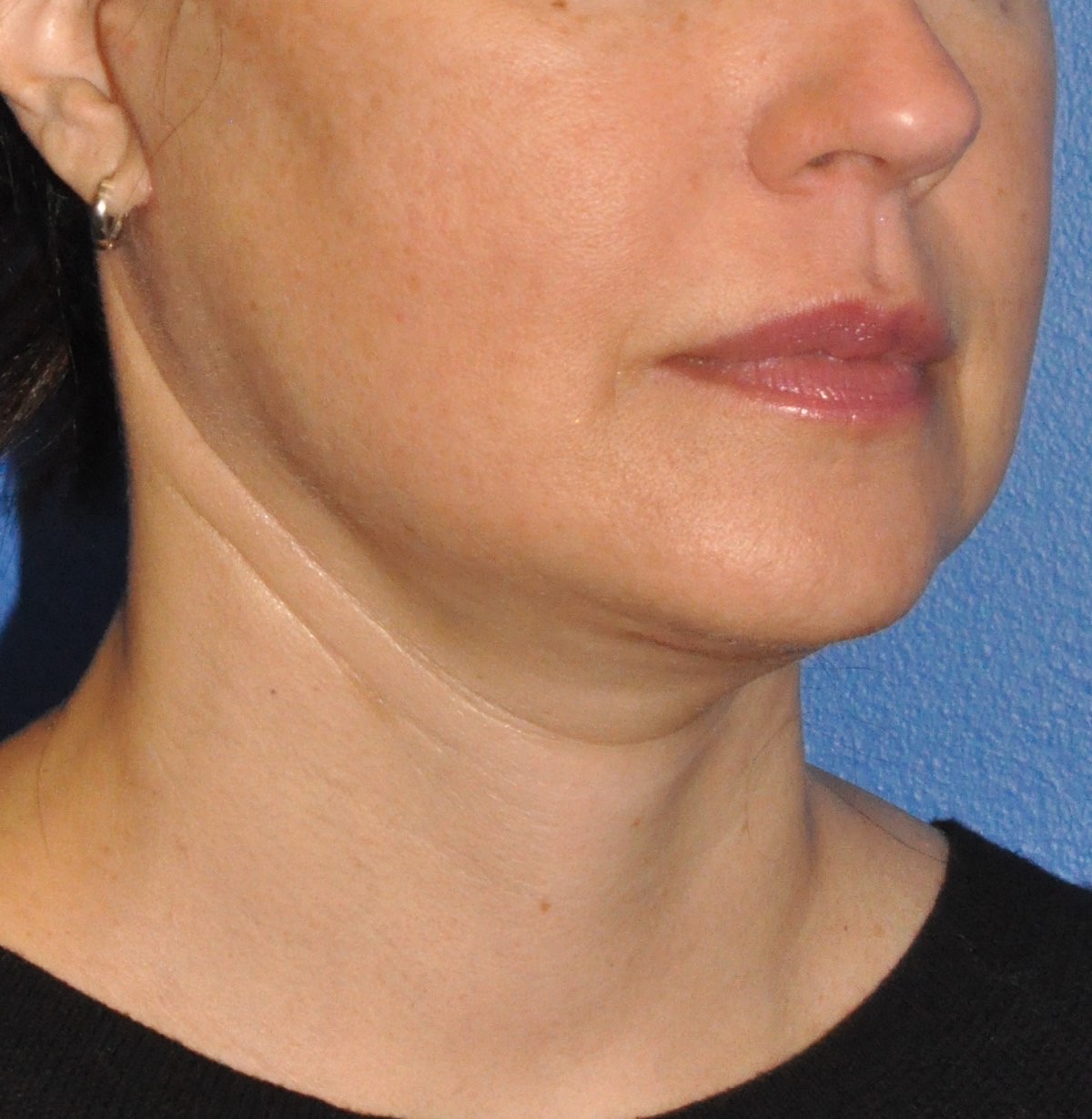 Face & Neck Lift