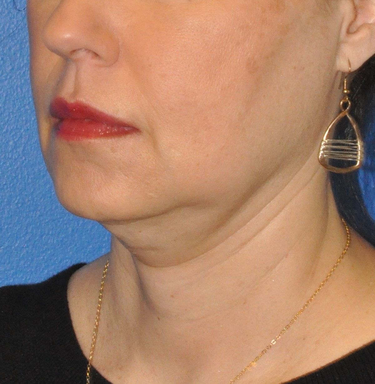 Face & Neck Lift