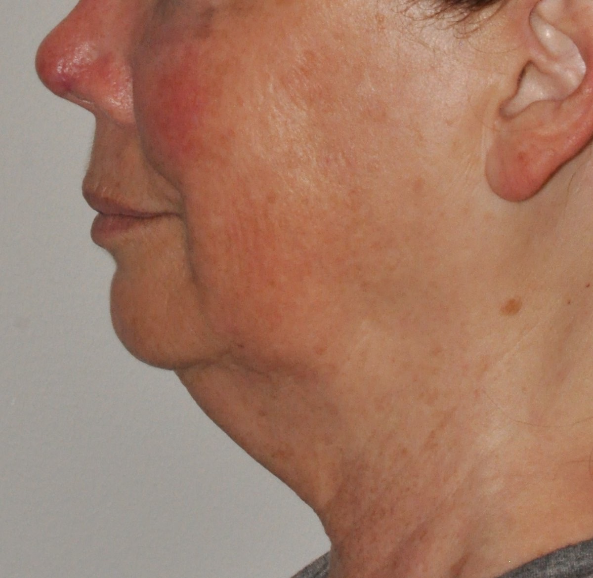 Face & Neck Lift