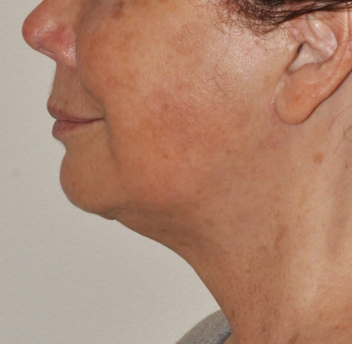 Face & Neck Lift