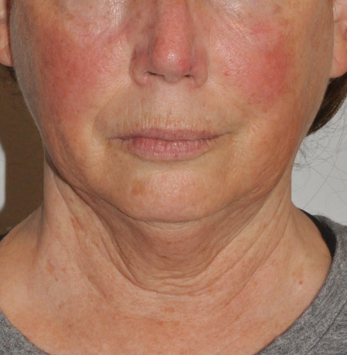 Face & Neck Lift