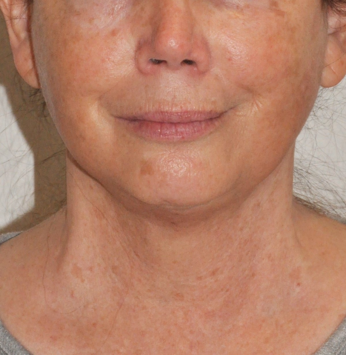 Face & Neck Lift